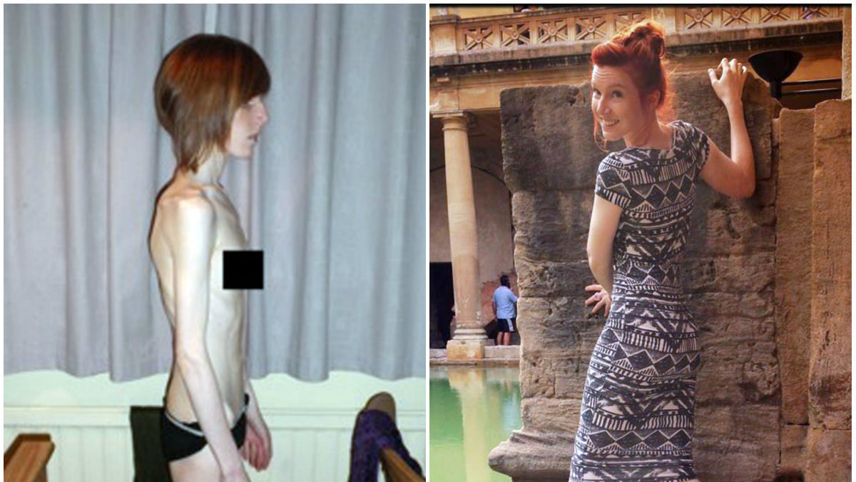 Kairėje: Beth Hall serganti anoreksija, dešinėje: Beth Hall šiuo metu / „Scanpix“/„Caters News Agency“ nuotr.